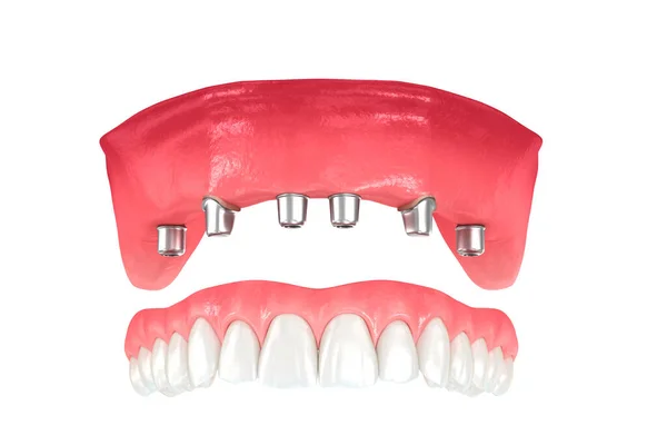 Maxillaire Prothese Ondersteund Door Tanden Implantaten Tandheelkundige Illustratie — Stockfoto