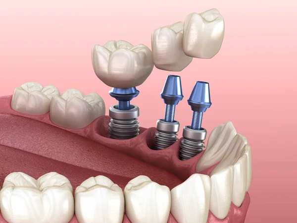 Zubní Korunky Umístění Přes Implantáty Koncept Zubní Ilustrace — Stock fotografie