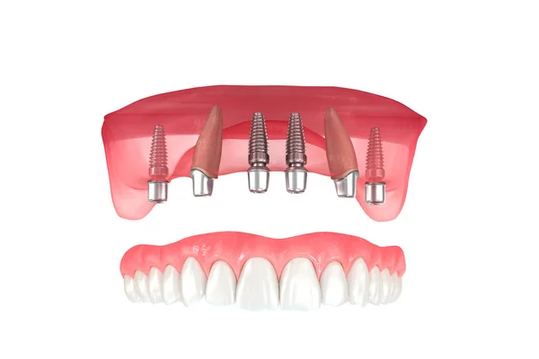 Prothèse Maxillaire Soutenue Par Dents Implants Illustration Dentaire — Photo
