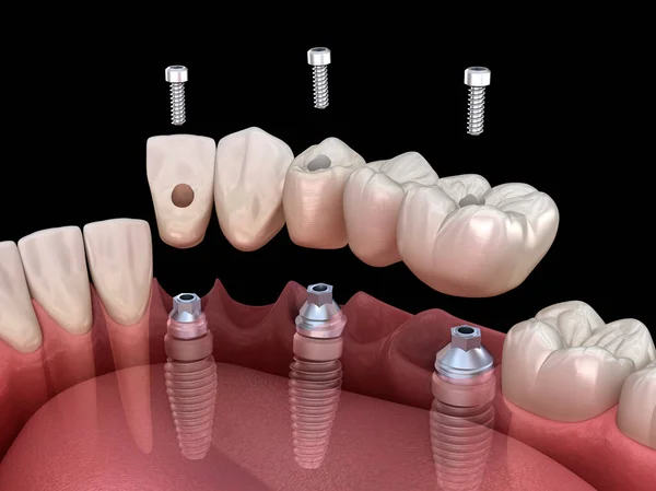 Zahnbrücke Auf Basis Von Implantaten Zahnärztliche Illustration — Stockfoto