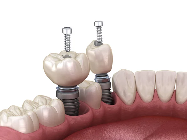 Prämolare Und Molare Zahnkrone Über Implantat Schraubfixierung Illustration Der Zahnärztlichen — Stockfoto