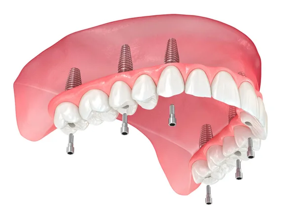 上颌假肢 牙龈全部在6个系统上 植入物支持 牙科3D图解 — 图库照片