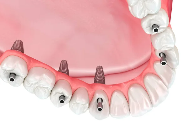 インプラントでサポートされている6つのシステム上のすべてのガムと上顎の義肢 歯科用3Dイラスト — ストック写真