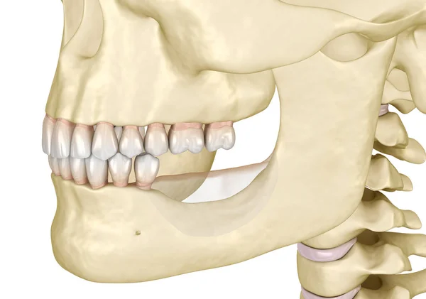 Mandibular Jaw Bone Recession Losing Molars Teeth Dental Illustration — Stock Photo, Image