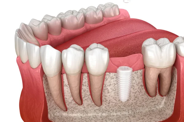 セラミックインプラント上のモル歯冠のインストール 歯科用3Dイラスト — ストック写真