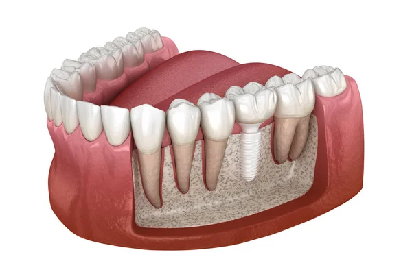 Installazione Corona Molare Sopra Impianto Ceramico Illustrazione Dentale — Foto Stock