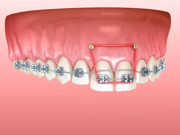 Elastik Und Metallspangen Zur Korrektur Des Überbisses Der Frontschneidezähne Zahnärztliche — Stockfoto