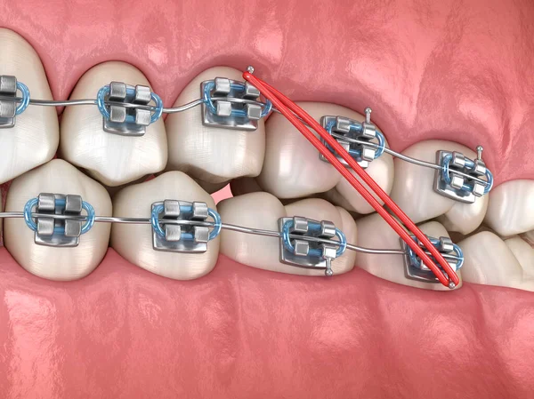 Elastics Metal Braces Correction Dental Bite Dental Illustration — Stock Photo, Image
