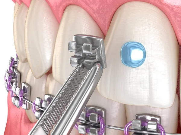 Metal Braces Installation Process Dental Illustration — Stock Photo, Image