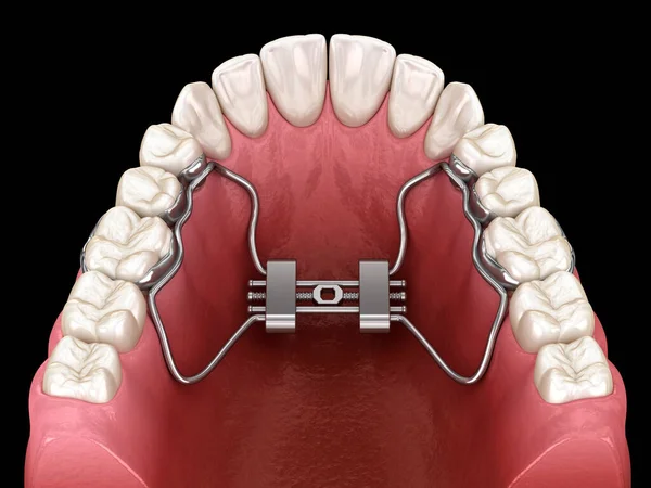 Expansão Palatina Rápida Ilustração Dental — Fotografia de Stock