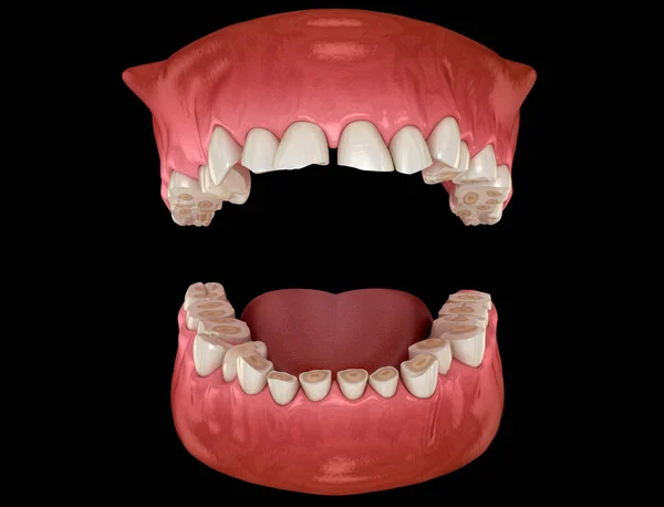 Desgaste Dental Bruxismo Que Resulta Pérdida Tejido Dental Ilustración Dental —  Fotos de Stock