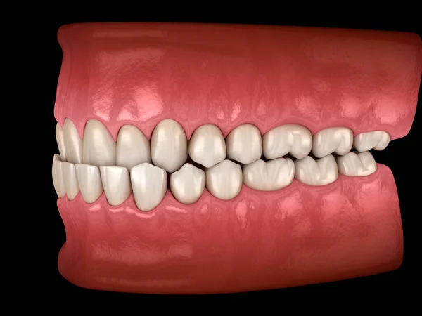 Oclusão Dentária Subdentária Oclusão Dos Dentes Ilustração Dental — Fotografia de Stock