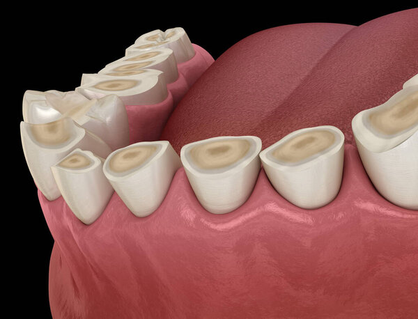 Вымирание зубов (бруксизм), приводящее к потере ткани зуба. Стоматологическая 3D иллюстрация