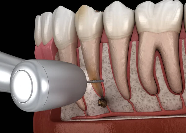 Cirurgia Cistectomia Dentária Recuperação Após Periostite Ilustração Dental Fotos De Bancos De Imagens