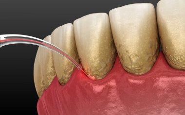 Lazer tartarı, enfekte olmuş deri tabakasını ve diş temizliğini temizler. Tıbbi olarak doğru diş 3D illüstrasyon