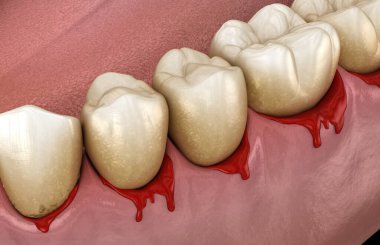 Diş eti kanaması ya da Periodontal - sakız ve kemik desteğinin patolojik iltihaplanma durumu. Diş 3B illüstrasyon