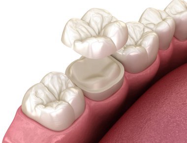 Diş üzerinde Onlay seramik taç fiksasyon. İnsan diş tedavisi tıbbi olarak doğru 3d illüstrasyon