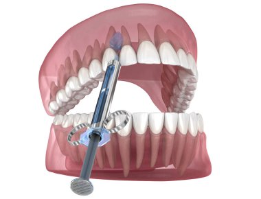 Yerel Dişçi Anestezisi. Diş tedavisinin 3B illüstrasyonu