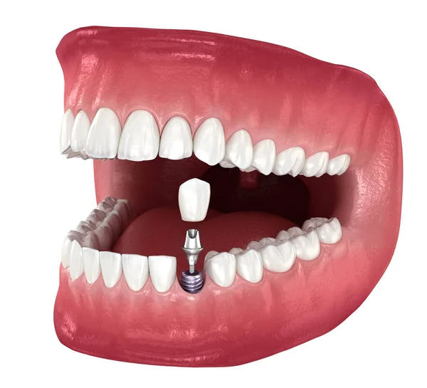 Implante Dentário Coroa Cerâmica Ilustração Dente Medicamente Precisa — Fotografia de Stock