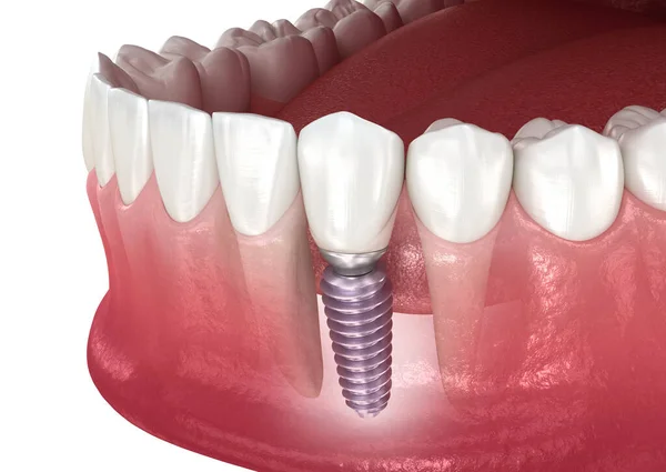 Implante Dental Corona Cerámica Ilustración Dientes Médicamente Precisos — Foto de Stock