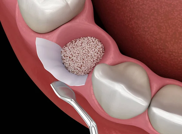 stock image Augmentation Surgery - Adding bone after tooth extraction. 3D illustration