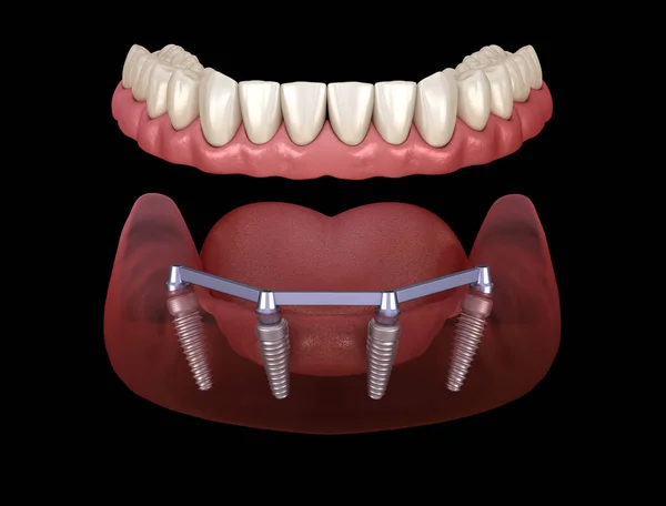 ガムで顎関節のプロテーゼインプラントでサポートされている4つのシステムのすべて 人間の歯と入れ歯の概念の医学的に正確な3Dイラスト — ストック写真