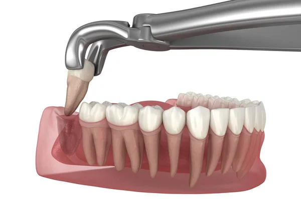 Extrakce Zubu Moudrosti Lékařsky Přesná Zubní Ilustrace — Stock fotografie