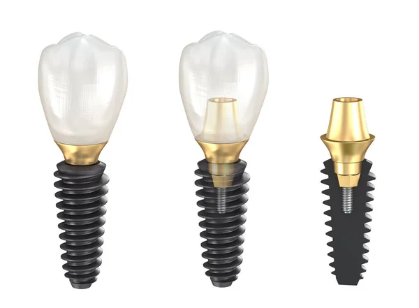 Implants Dentaires Couronne Céramique Illustration Dentaire Médicalement Précise — Photo