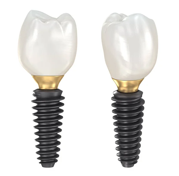 Implant Stomatologiczny Korona Ceramiczna Medycznie Dokładna Ilustracja Zęba — Zdjęcie stockowe