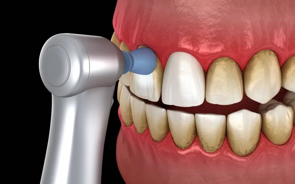 プロのブラシとゲルで歯研磨手順 歯科用3Dイラスト — ストック写真