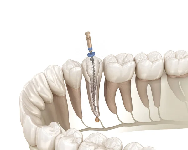 Процесс Лечения Эндодонтического Корневого Канала Медицинская Точность Трехмерной Иллюстрации Зубов — стоковое фото