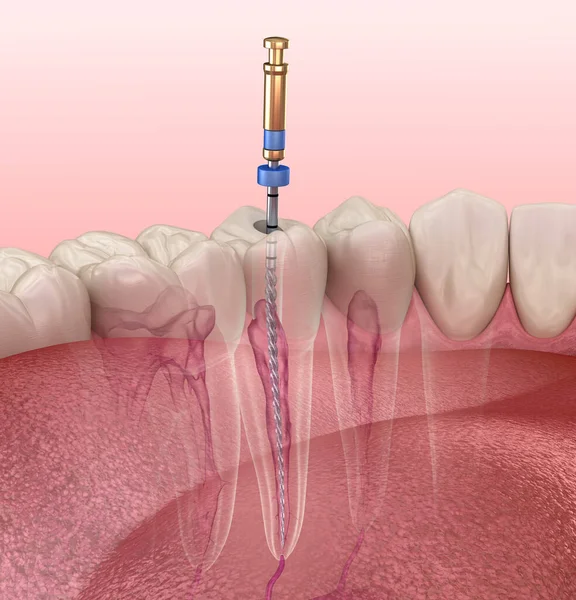 Processo Tratamento Canal Radicular Endodôntico Ilustração Dente Medicamente Precisa — Fotografia de Stock