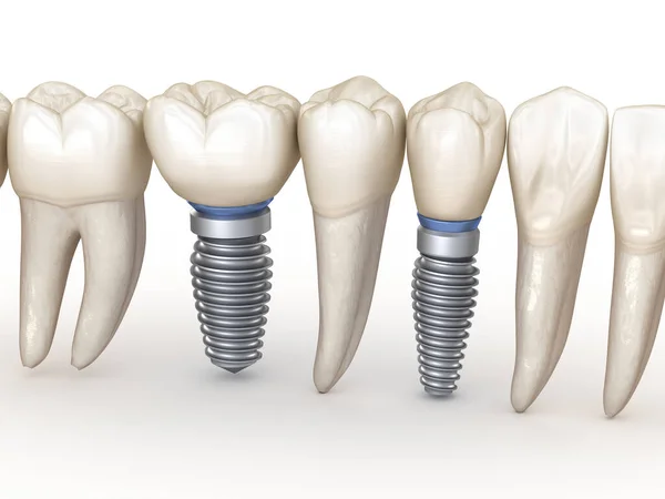 Dental Implants Teeth Line Illustration Concept Human Teeth — Stock Photo, Image