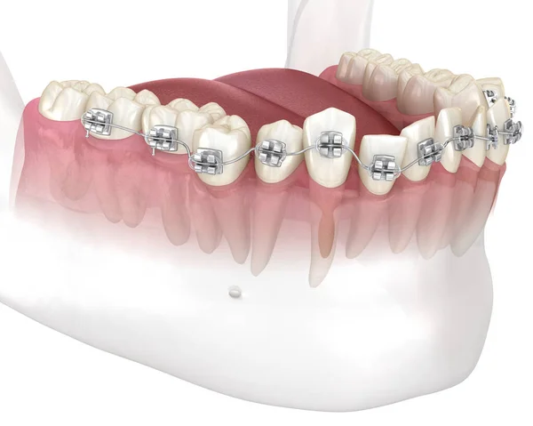 Nieprawidłowe Ustawienie Zębów Korekta Drżeniem Metalowych Aparatów Ortodontycznych Medycznie Dokładna — Zdjęcie stockowe
