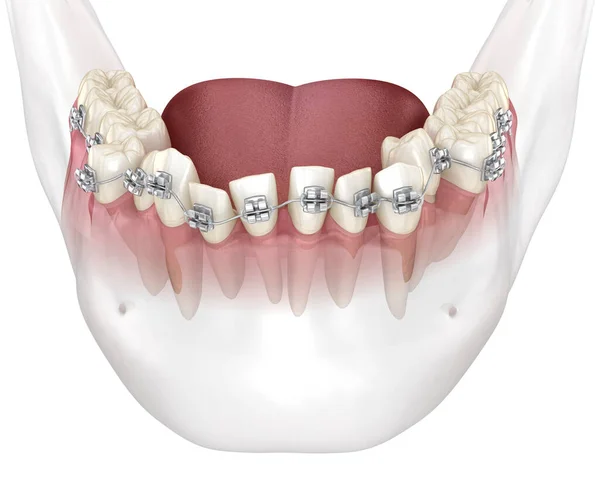Abnormální Pozice Zubů Korekce Kovovými Výztuhami Tretament Lékařsky Přesná Zubní — Stock fotografie
