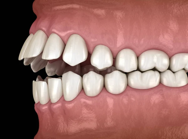 開口歯閉塞 歯の閉塞 医学的に正確な歯3Dイラスト — ストック写真