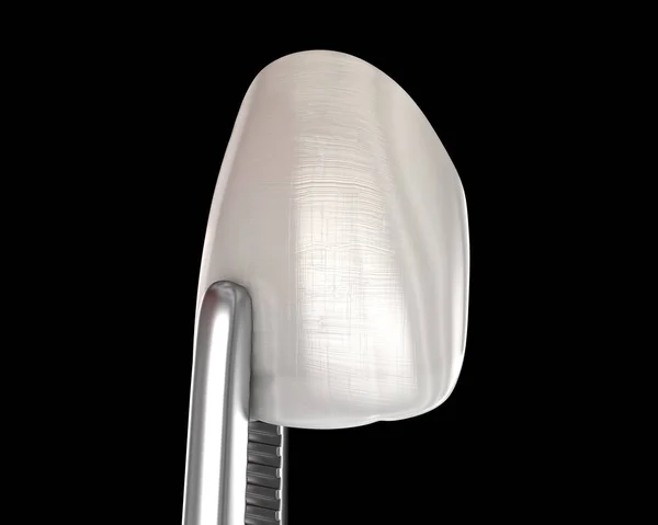在中央门牙上安装嵌板的程序 医学上准确的牙齿3D图像 — 图库照片