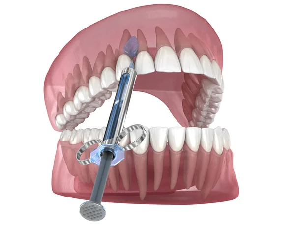 Lokale Zahnbetäubung Illustration Der Zahnärztlichen Behandlung — Stockfoto
