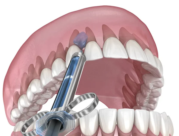 Plaatselijke Tandheelkundige Verdoving Illustratie Van Tandheelkundige Behandeling — Stockfoto