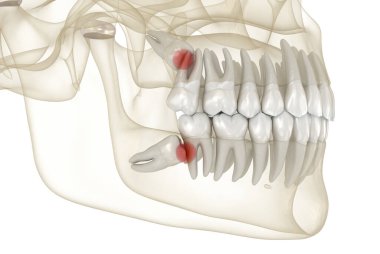 Yirmilik dişlerin ikinci azı dişine yaptığı darbe. Tıbbi olarak doğru diş 3D illüstrasyon
