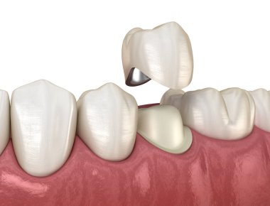 Hazırlanmış azı dişi ve diş metal seramik kaplama. Tıbbi olarak doğru 3d illüstrasyon