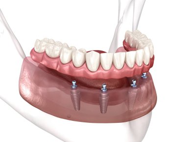 Removable prosthesis All on 4 system supported by implants. Medically accurate 3D illustration of human teeth and dentures concept clipart