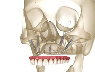 Elmacık kemiği implantları tarafından desteklenen Maxillary protezi. İnsan dişlerinin ve protezlerinin tıbbi açıdan doğru üç boyutlu çizimi
