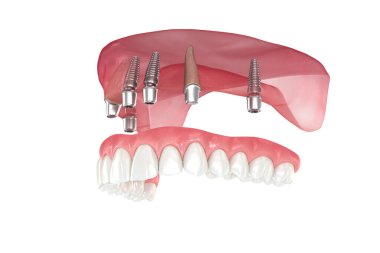 Maxillary protezi 2 diş ve 4 implantla destekleniyor. Diş 3B illüstrasyon