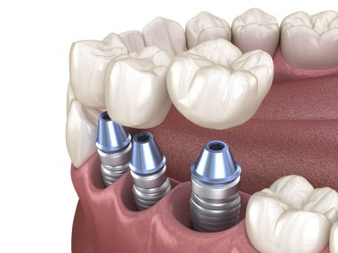 3 implantın üzerine 3 diş yerleştirme - kavram. Diş 3B illüstrasyon