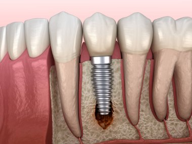 Görülebilir kemik hasarlı perisiplantit. Tıbbi olarak doğru 3B illüstrasyon