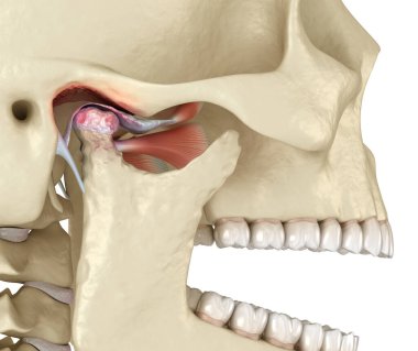 Temporomandibular eklem iltihabı ve yerinden çıkmış eklem diski. Tıbbi olarak doğru 3B illüstrasyon.