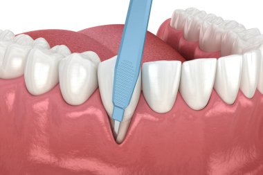 Sakız resesyonu, yumuşak doku nakli ameliyatı. Diş tedavisinin 3 boyutlu illüstrasyonu