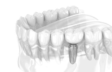 Diş implantı ve seramik kaplama. İnsan dişlerinin 3 boyutlu çizimi