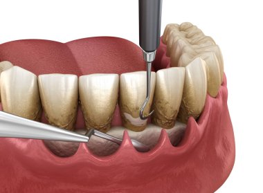 Açık curettage: Ölçekleme ve kök planlama (geleneksel periodontal terapi). İnsan diş tedavisinin tıbbi açıdan doğru üç boyutlu çizimi